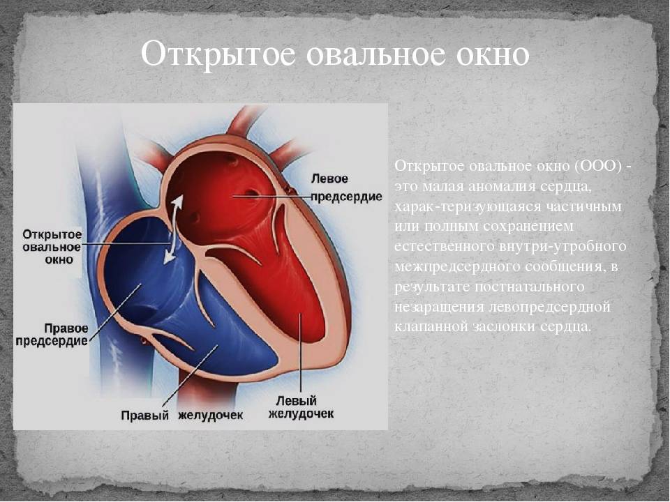 Открытое овальное окно в сердце - диагноз у ребенка, у новорожденного, у взрослых - docdoc.ru