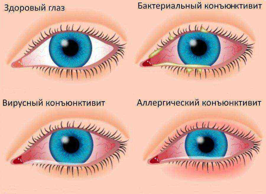 Красные глаза у ребенка - причины и лечение покраснения