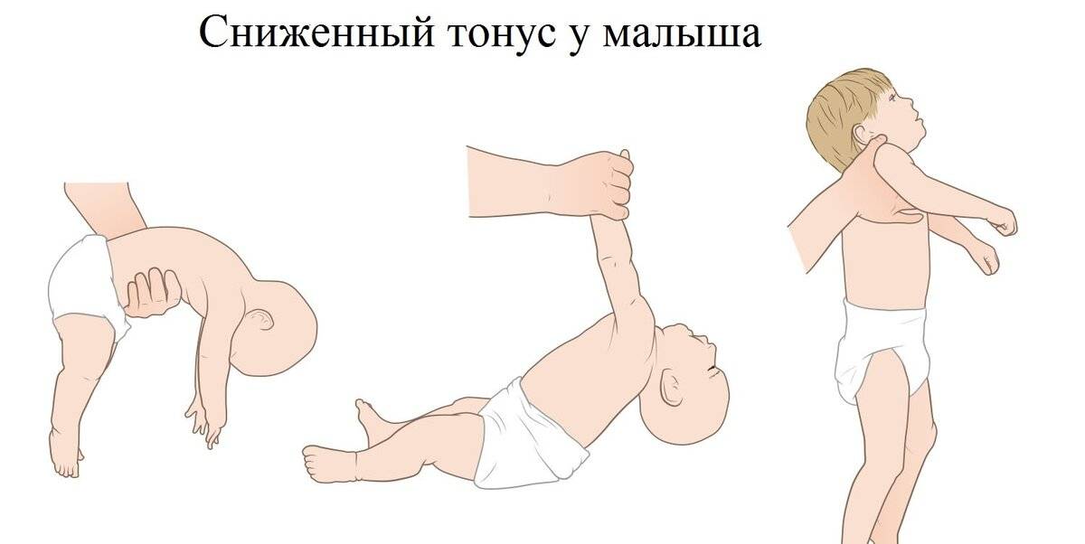 Что делать, если младенцу поставили диагноз «гипертонус мышц»?