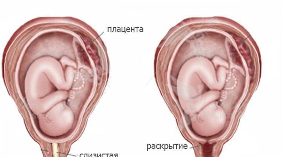 Скоро роды: когда и как отходит пробка при беременности?