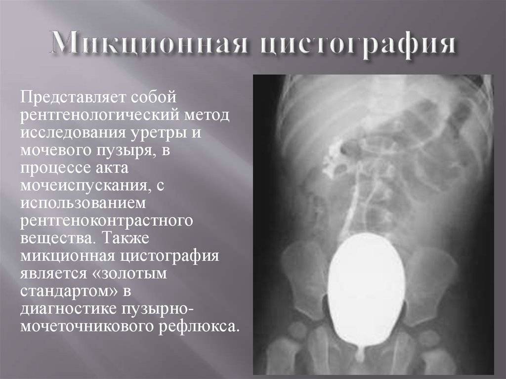Рентгенография мочевого пузыря (цистография) - цена, сделать рентген мочевого пузыря в клинике «мать и дитя» в москве