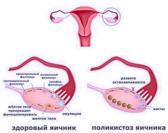 Сбой менструального цикла