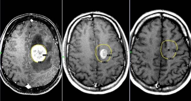 Опухоль лобной доли головного мозга: причины, симптомы, лечение — онлайн-диагностика
