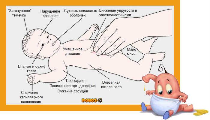 Как определить, что у грудничка обезвоживание - parents.ru