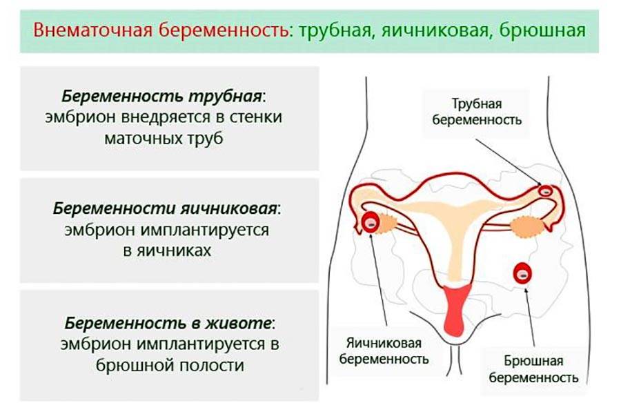 Пульсация в области яичников (правом, левом) - причины и лечение