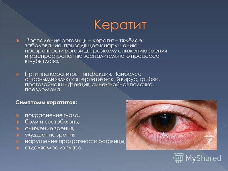 Экзофтальм (пучеглазие): что это, симптомы, причины, виды, лечение - энциклопедия ochkov.net