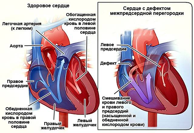 Врожденный порок сердца