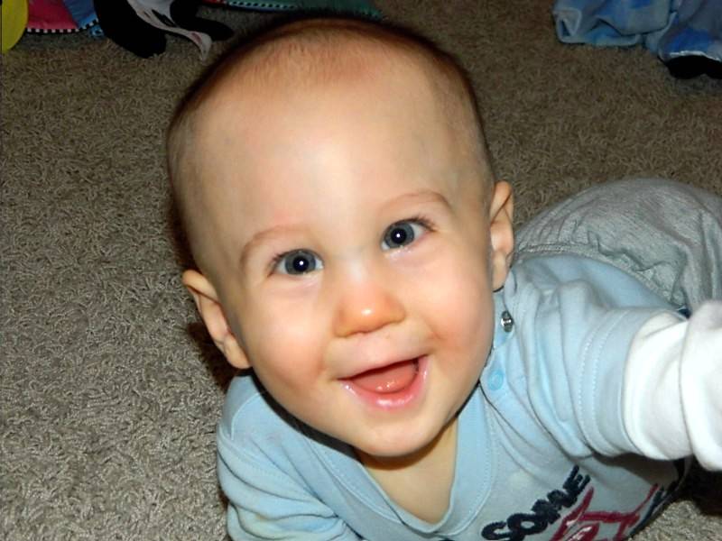 У ребенка выпирает лоб. Метопический краниосиностоз. Метопический краниосиностоз тригоноцефалия. Краниосиностоз метопический шов у ребенка.