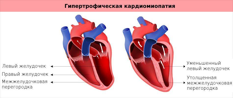 Дилатационная кардиомиопатия – причины, диагностика и лечение