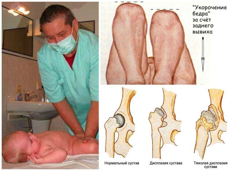 Артроз тазобедренного сустава 1, 2, 3 степени - симптомы, лечение, профилактика | артра