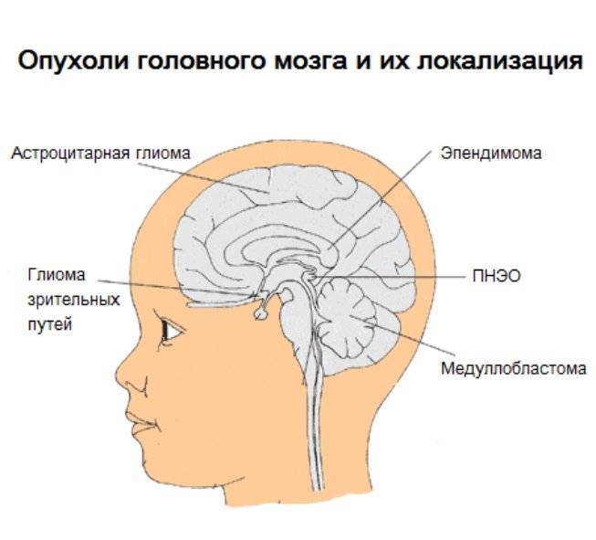 Опухоли головного мозга у детей - симптомы болезни, профилактика и лечение опухолей головного мозга у детей, причины заболевания и его диагностика на eurolab