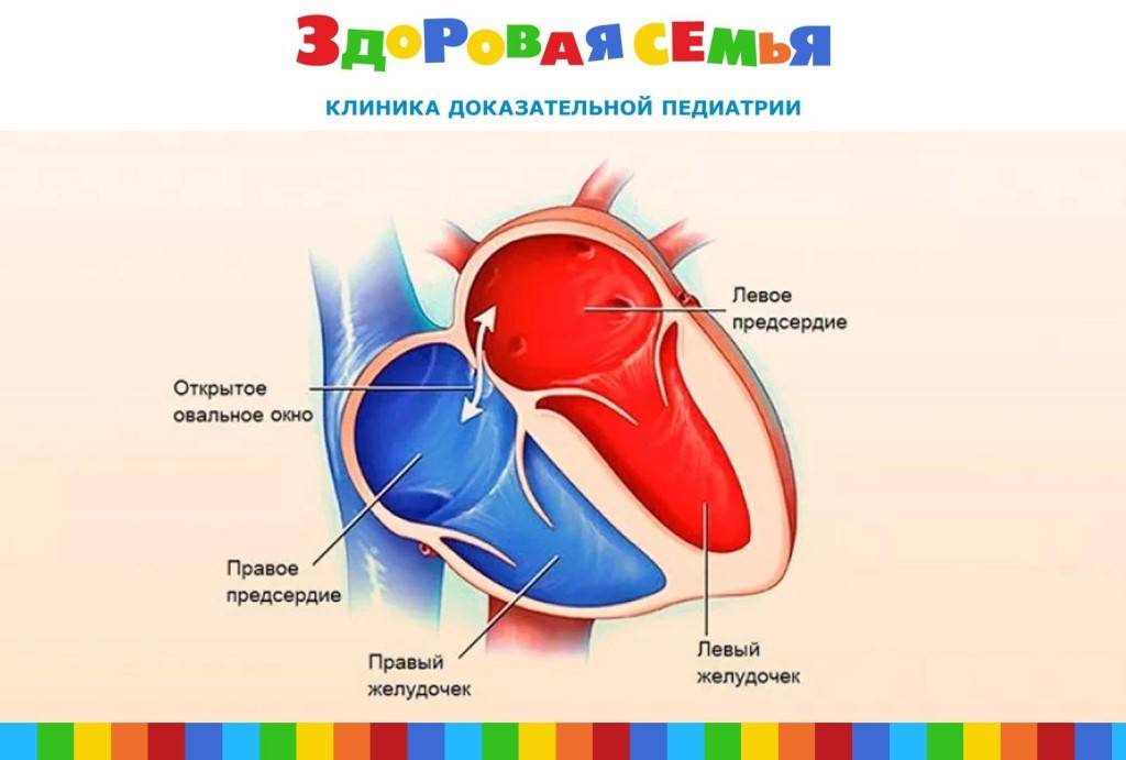 Пороки сердца у детей: аневризма межпредсердной перегородки — медицинский центр в махачкале «целитель»