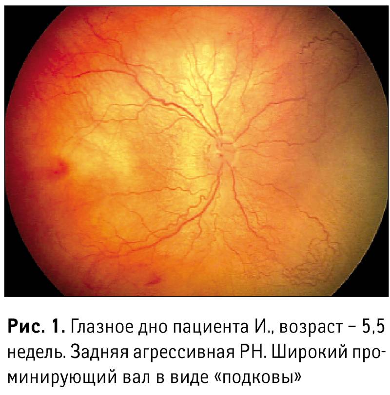 К каким осложнениям приводит ретинопатия недоношенных?
