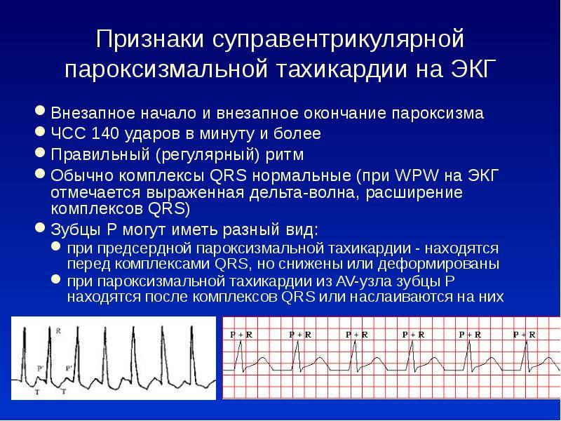 Учащенное сердцебиение (тахикардия). информация для пациентов - доказательная медицина для всех