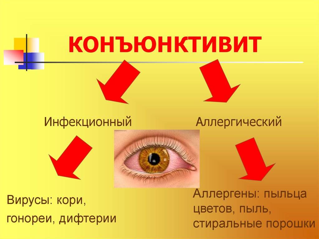 Вирусный конъюнктивит глаз: лечение у детей - энциклопедия ochkov.net