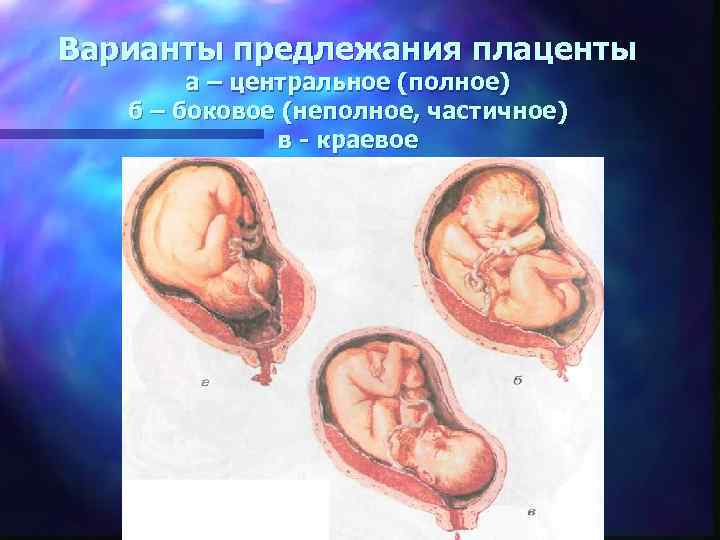 13 неделе беременности плацента. Центральное предлежание плаценты. Отслойка плаценты хориона. Частичное предлежание хориона. Неполное предлежание хориона на 13 неделе.