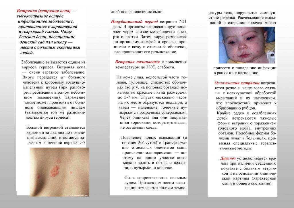 Ветрянка у детей и взрослых. сколько дней болеют ветряной оспой?