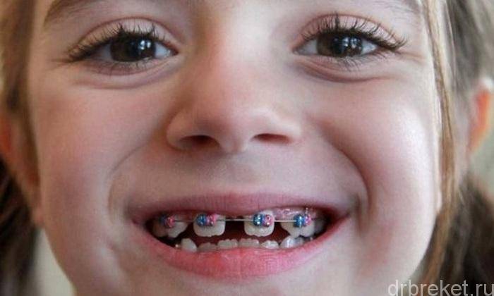 Пластины для выравнивания зубов у детей