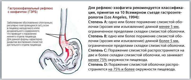 Гастроэзофагеальная рефлюксная болезнь (гэрб)