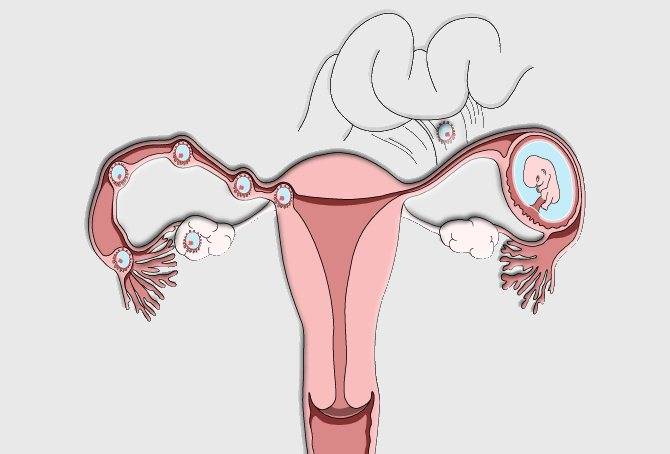 Как забеременеть двойняшками с помощью эко - статья репродуктивного центра «за рождение»