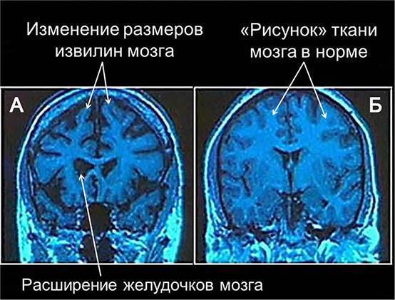 Расширение желудочков головного мозга у грудничка