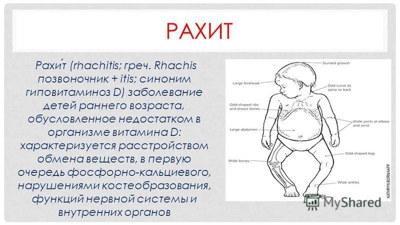 Рахит – признаки и симптомы, лечение, профилактика - сибирский медицинский портал
