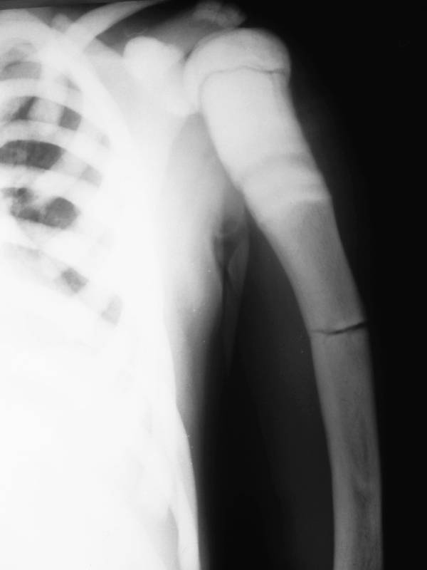 Остеопороз: симптомы и лечение. профилактика и диагностика остеопороза суставов.