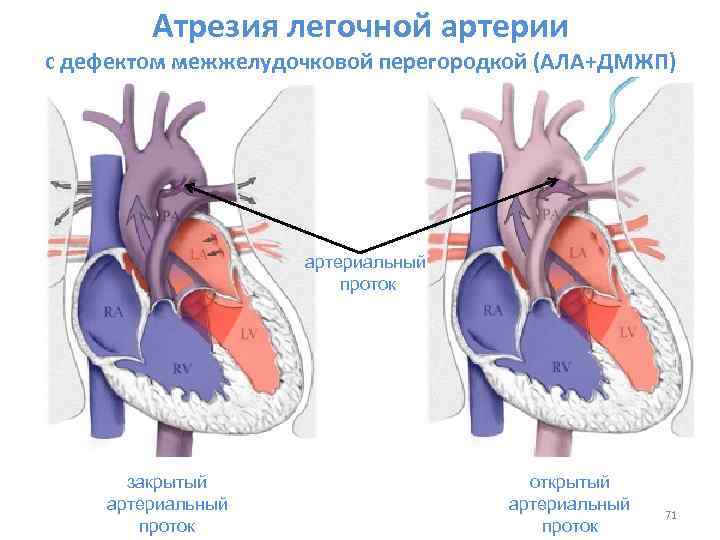 Дефект межжелудочковой перегородки                (дмжп, врожденный порок сердца, роже болезнь, эйзенменгера синдром)