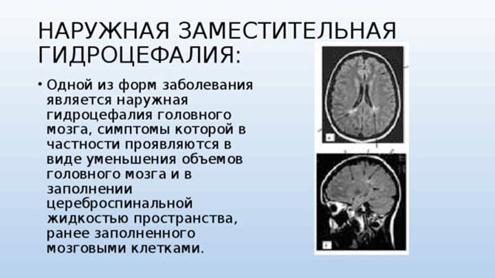 Гидроцефалия - нейрохирургическая операция в москве