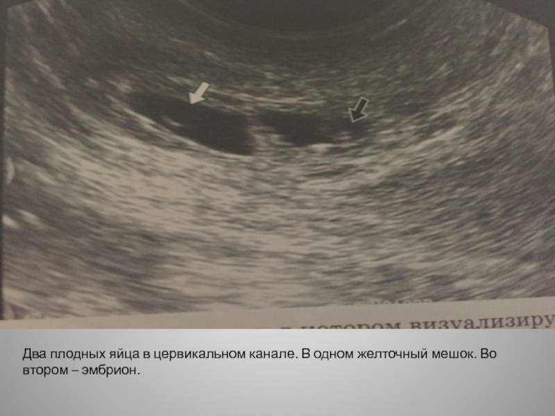 На узи не видно эмбриона: причины