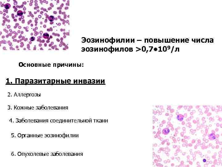 Эозинофилия | повышенный уровень в крови клеток-эозинофилов | амо