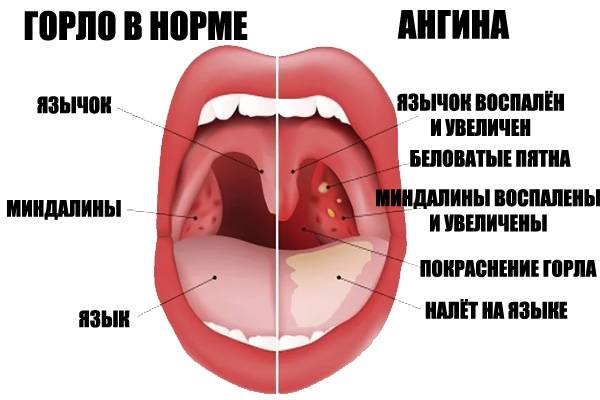 Кандидоз