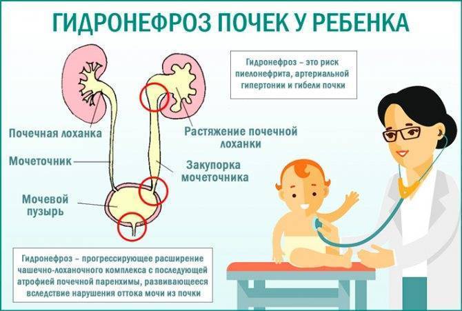 Причины гидронефроза почки у плода при беременности, диагностика и лечение