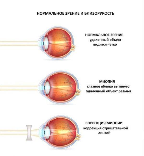 Осложненная катаракта - что это такое? лечение осложненной катаракты в клинике fedorovmedcenter.ru