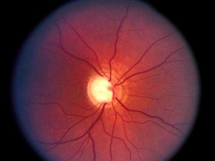 Ретинопатия глаз лечение. виды ретинопатии диагностика.
