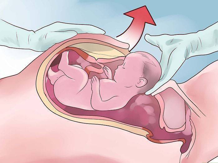 Могут ли с пессарием начаться схватки - все о беременности