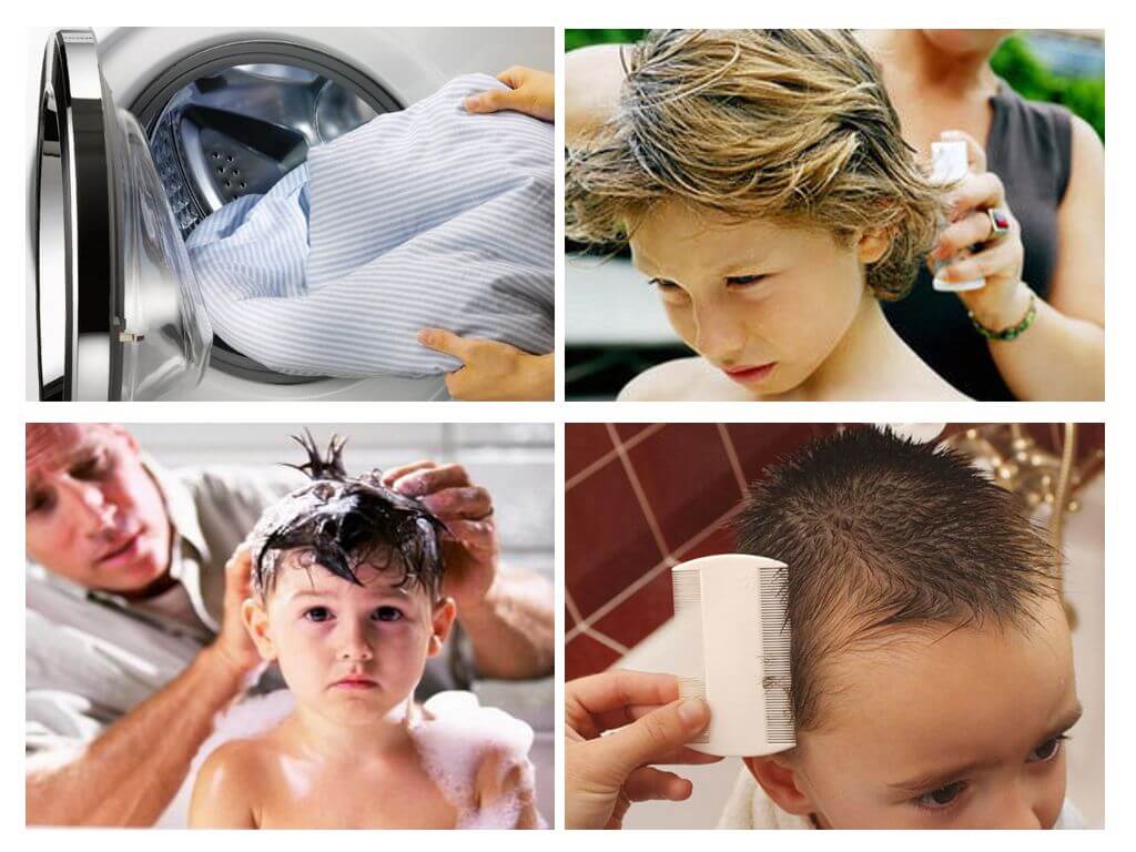 Выпадение волос у детей и подростков