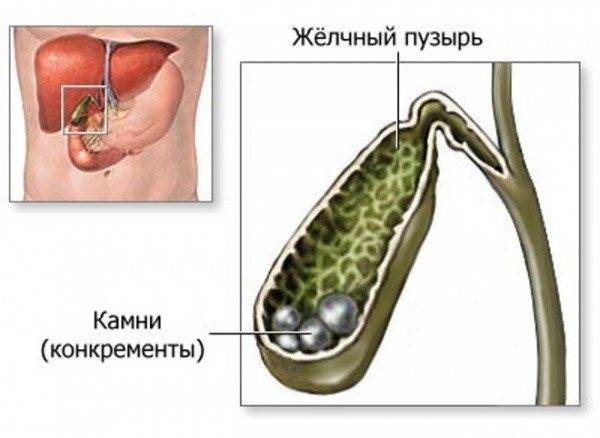 Желтуха. признаки, диагностика и лечение желтухи!