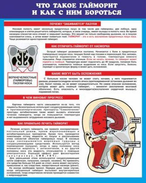 Одонтогенный гайморит - как распознать и успешно вылечить заболевание?