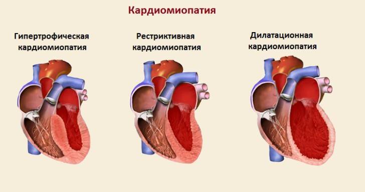 Кардиомиопатия (кмп). классификация кардиомиопатий. диагностика и лечение