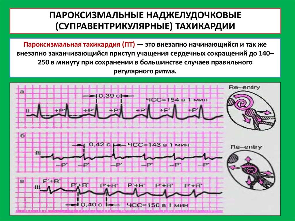 Сердцебиение и тахикардия