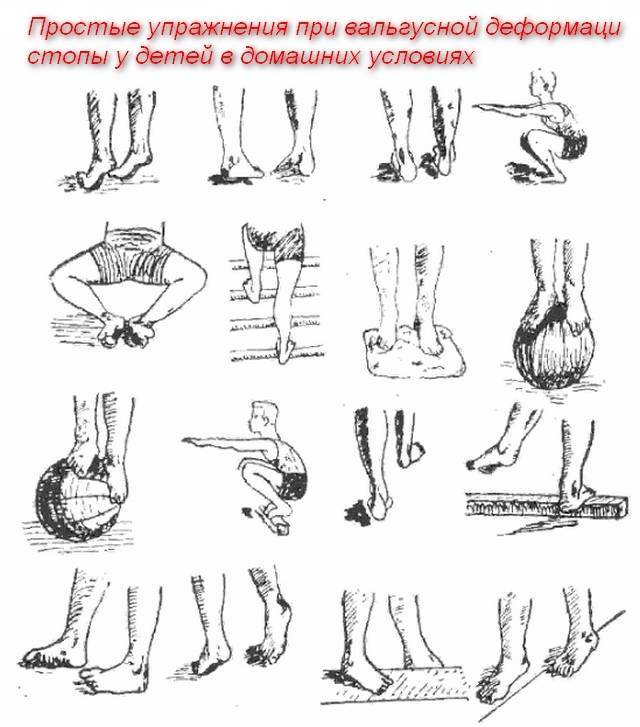 Косточка на ноге (вальгусная деформация): лечение халюс вальгус - напоправку – напоправку