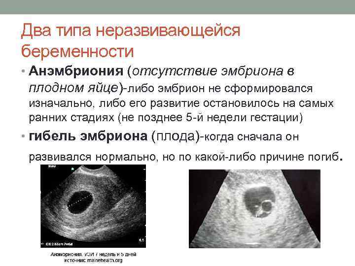 На узи не видно эмбриона. причины и что делать?