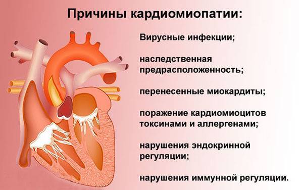 Кардиомиопатия: симптомы, причины. первичная, вторичная. дилетационная, гипертрофическая, рестриктивная, ишемическая кардиомиопатия сердца