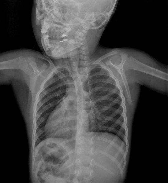 В каких случаях после флюорографии врач может отправить пациента на рентген, и могут ли оба обследования проводиться в один день?