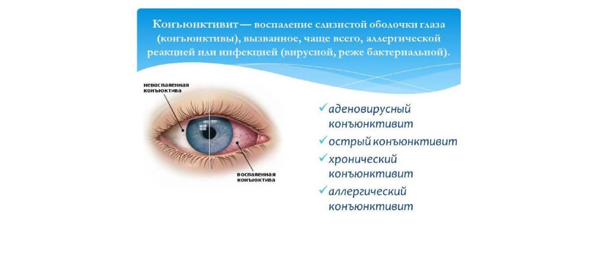 Чем лечить вирусный конъюнктивит у ребенка?