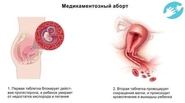Какие таблетки назначают для прерывания беременности * клиника диана