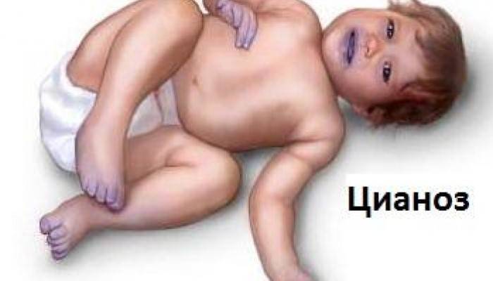Синеет носогубный треугольник у грудничка: причины цианоза у ребенка (комаровский)