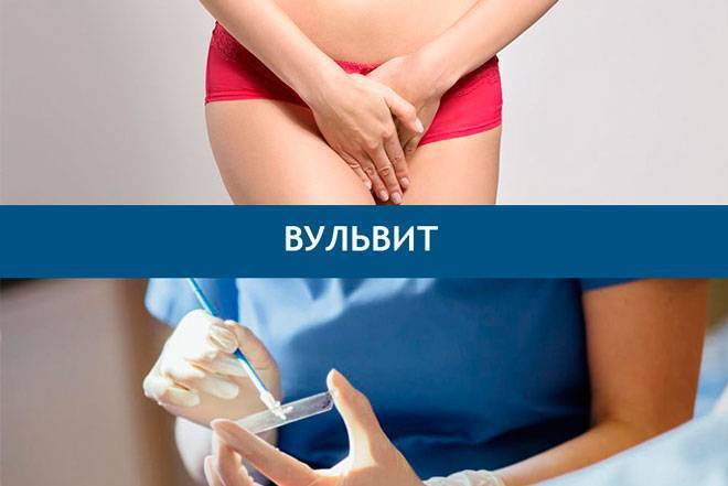 Лечение вульвита и вульвовагинита у женщин. клиника семейный доктор
