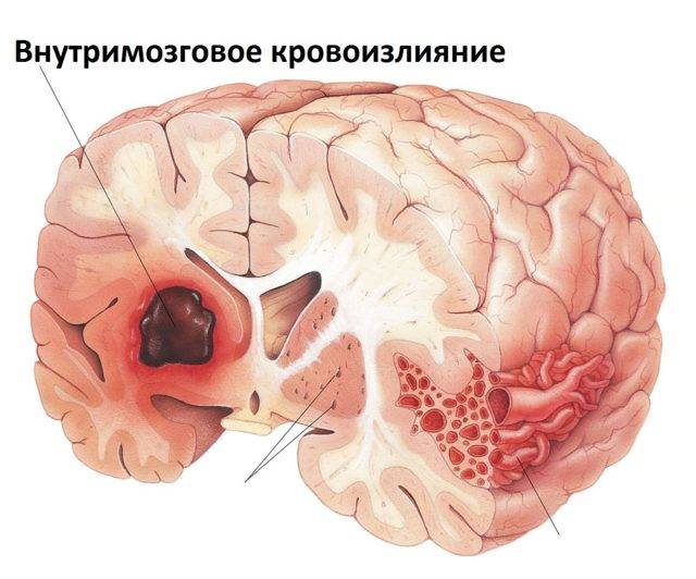 Псевдокиста в голове у новорожденного: причины, лечение, мнение Комаровского